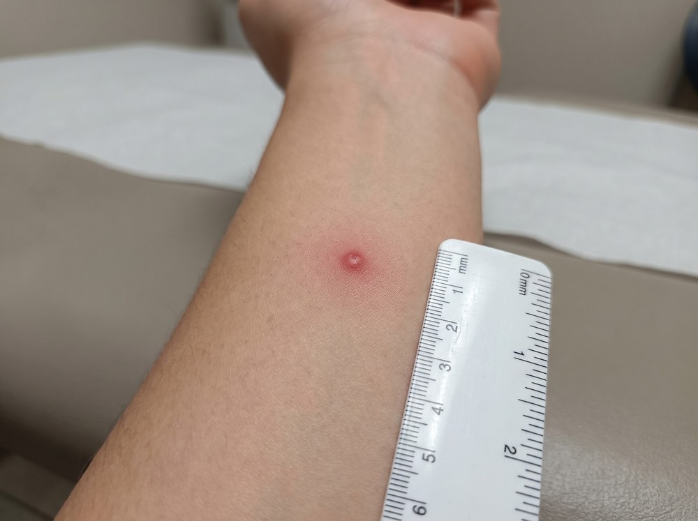 Close-up of a fresh blister beetle skin reaction showing a raised red welt with a clear fluid-filled blister forming at the center