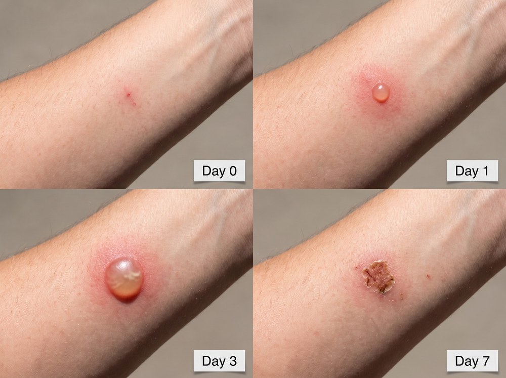 Side-by-side labeled comparison image of a blister beetle skin reaction versus a brown recluse spider bite showing different blister and ulcer patterns